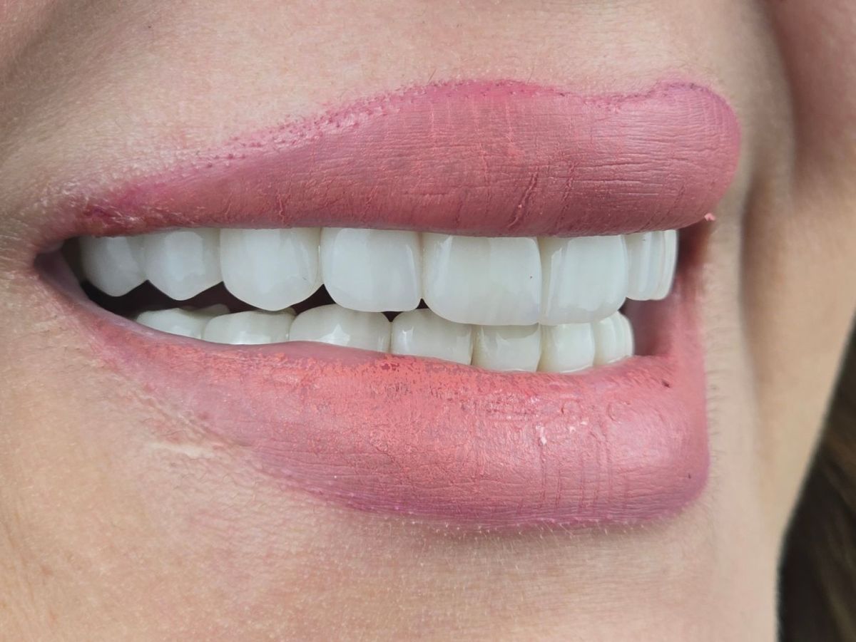 Veneer Transformation - after