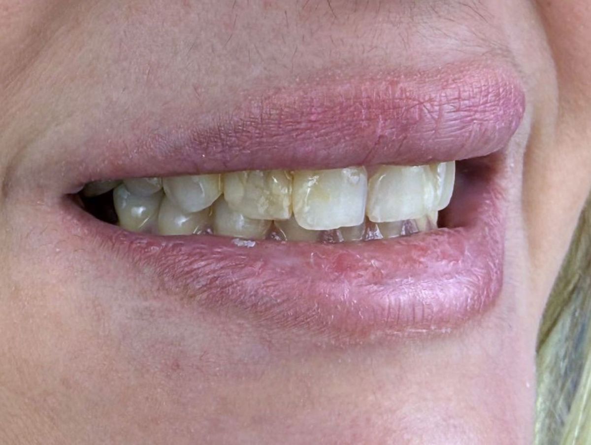 Veneer Transformation - before