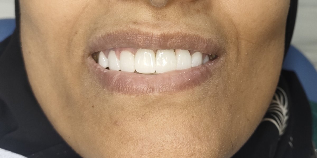Implants After Tooth Loss - after