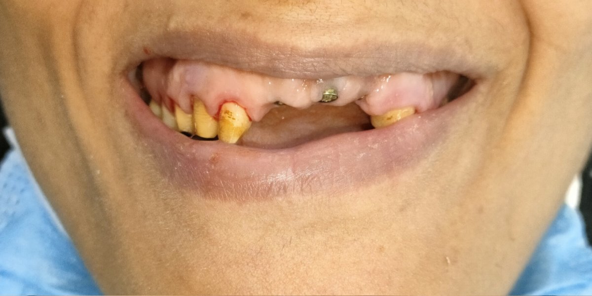 Implants After Tooth Loss - before