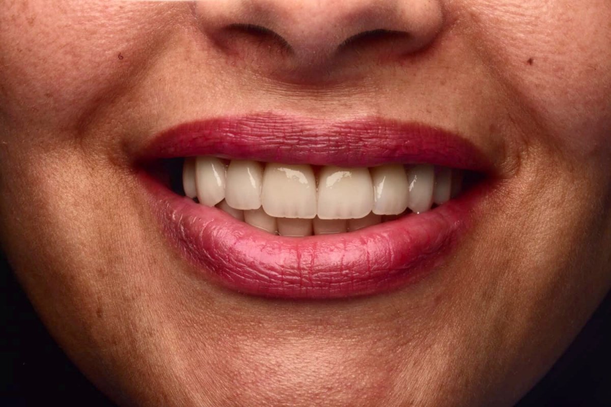 Veneers on Worn Teeth - after