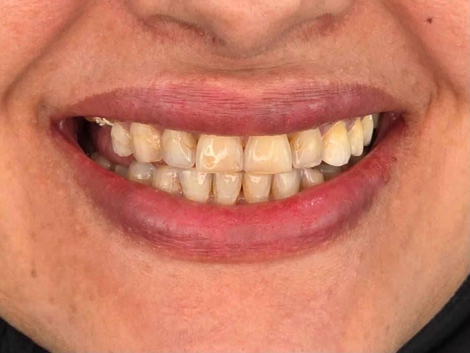 Veneers on Worn Teeth - before