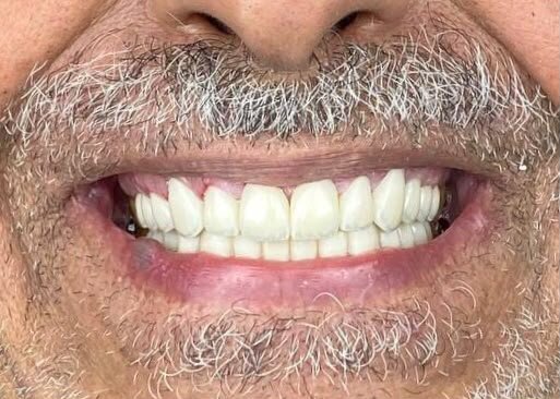 Full Arch Implants - after