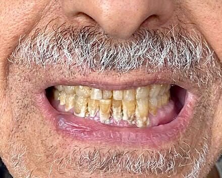 Full Arch Implants - before