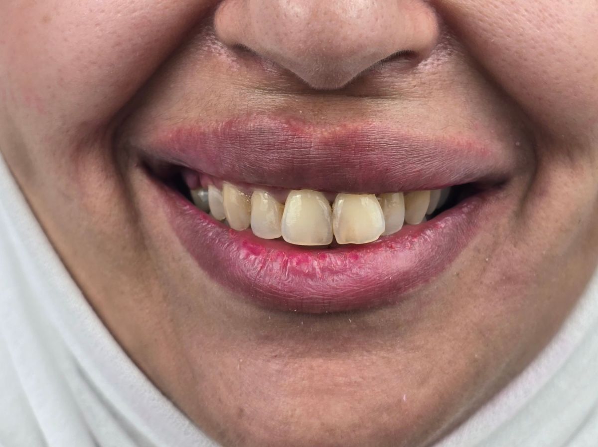 Full Smile Makeover - after