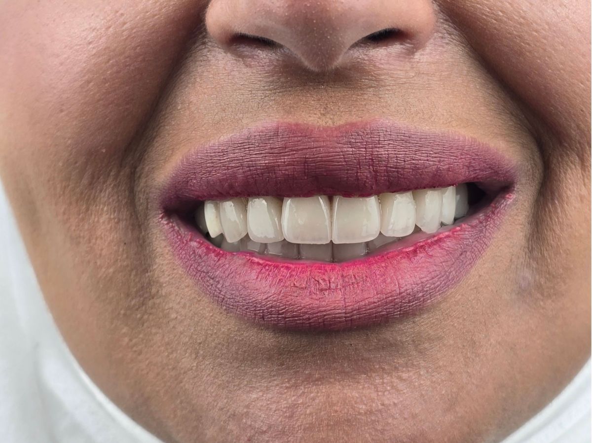 Full Smile Makeover - before