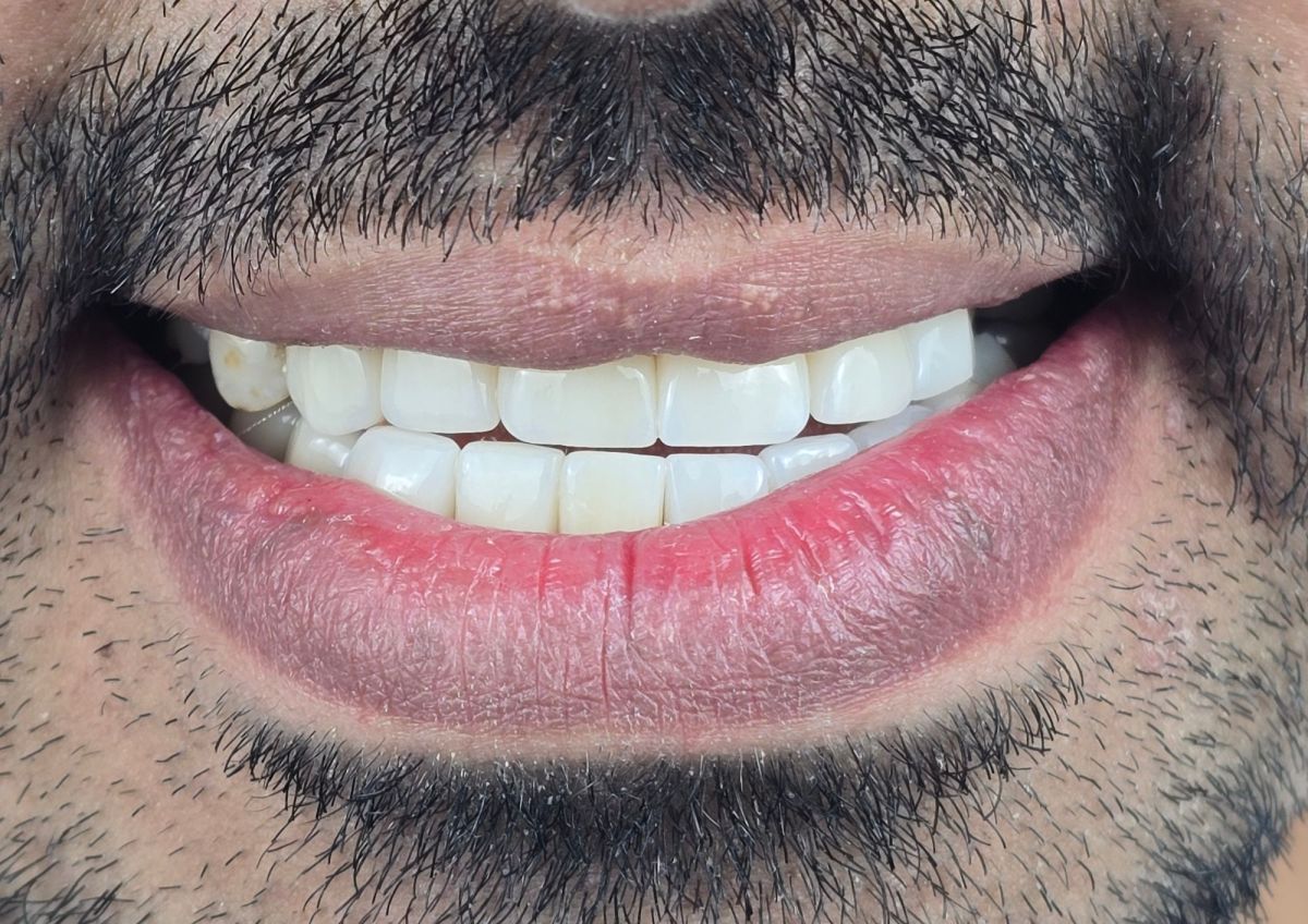 Full Mouth Reconstruction - after