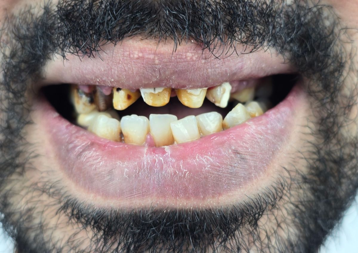Full Mouth Reconstruction - before