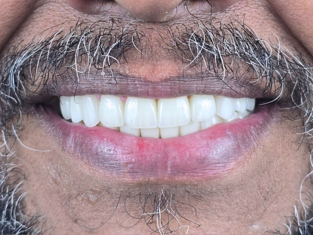 Crowns for a Dead Front Tooth - after