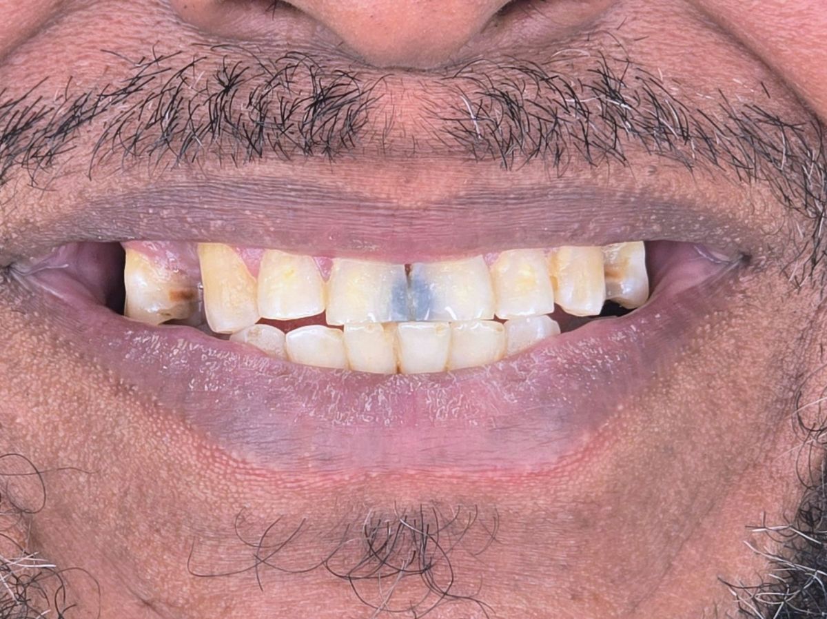Crowns for a Dead Front Tooth - before