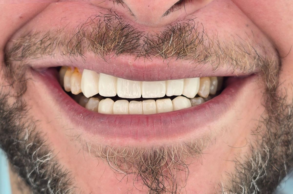 Single Implant Replacement - after