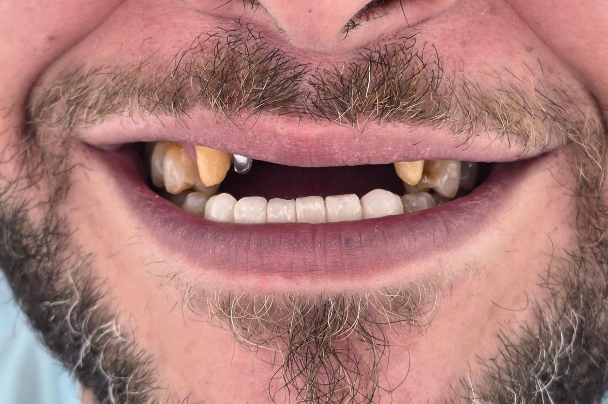 Single Implant Replacement - before