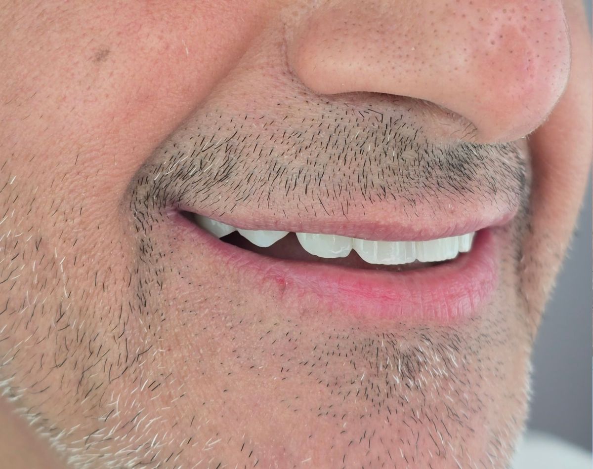 Full Arch Implants - after