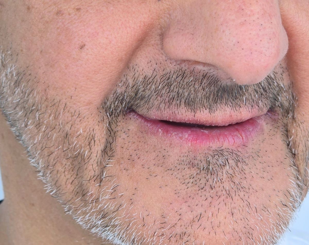 Full Arch Implants - before