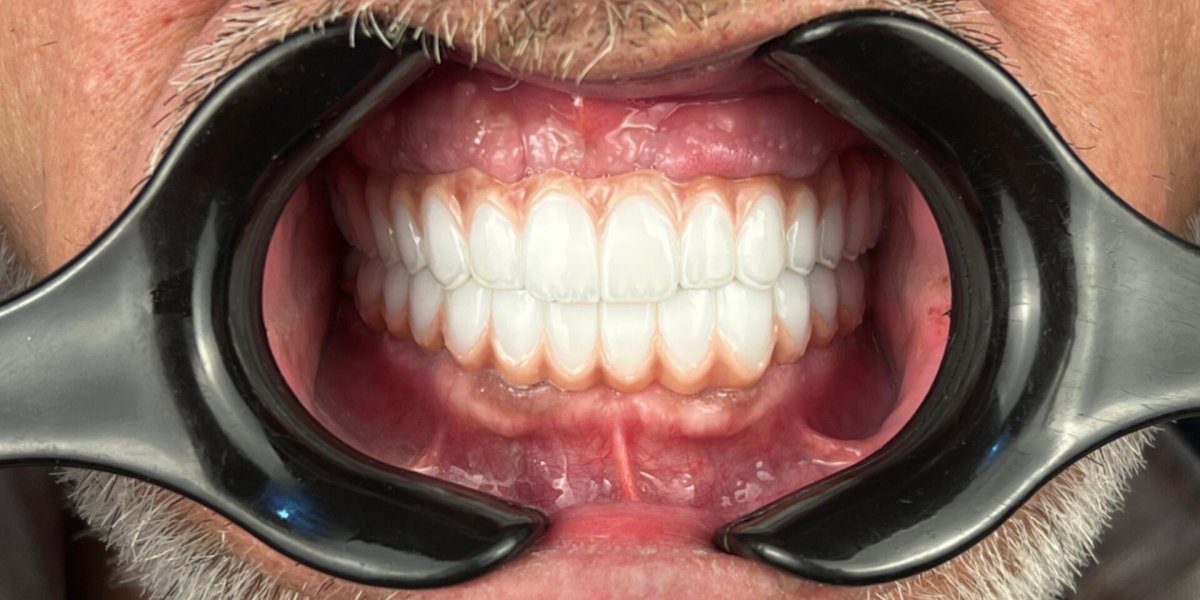 Full Arch on Implants — Both Jaws - after