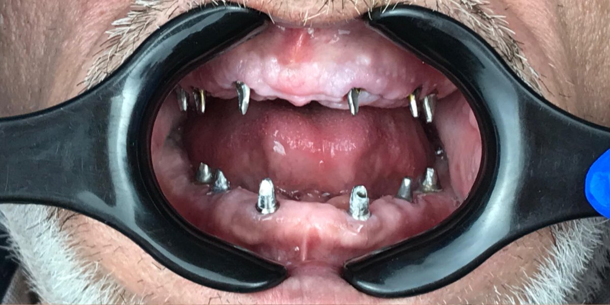 Full Arch on Implants — Both Jaws - before